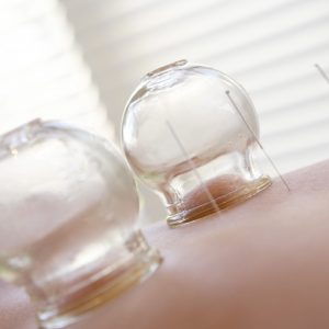 Acupuncture needles and glass shapes on woman's back